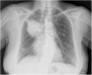 Rx de tórax: masa tumoral perihiliar en lóbulo superior derecho que compromete bronquio principal derecho y parece invadir mediastino. Existen otras lesiones pulmonares difusas, nodulares, compatibles con diseminación pulmonar neoplásica bilateral.