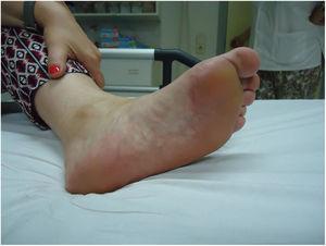 Tumoración de consistencia fibrosa en el tercio medio de la región plantar del pie izquierdo.