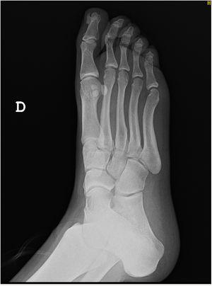 Radiografía de pie derecho con exóstosis ósea en falange distal del primer dedo.