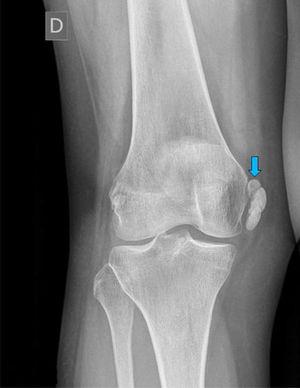 Radiografía simple de rodilla, donde se aprecia calcificación en el LCIF (flecha azul).