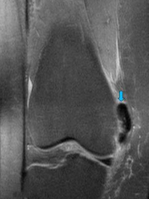 RNM en donde vemos la calcificación en negro de 26×23mm en receso cuadricipital interno, adyacente al ligamento colateral medial al cual deforma sus fibras más anteriores (flecha azul).