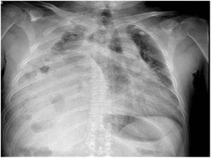 Radiografía tórax decúbito. Densidad partes blandas y niveles hidroaéreos en el hemitórax derecho.