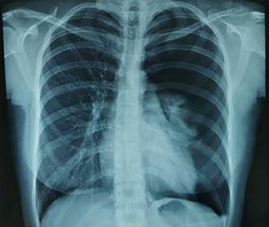 Radiografía de tórax simple postero-anterior.