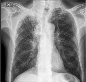 Radiografía de tórax AP y lat.: se observa un área con aumento de la densidad mal definida con infiltrado intersticial hacia la región del lóbulo superior derecho.