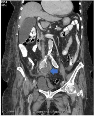 Tomografía de abdomen con doble contraste. La flecha muestra aneurisma fusiforme de la arteria ilíaca común derecha con presencia de colección con signos de sobreinfección adyacente.