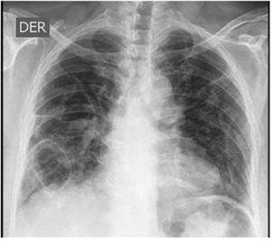 Radiografía de tórax con cambios por fibrosis con una gran caverna en la base pulmonar derecha.
