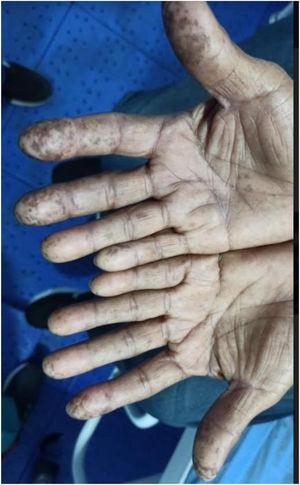 Región dactilar de las manos con máculas hiperpigmentadas de color marrón oscuro a negro.