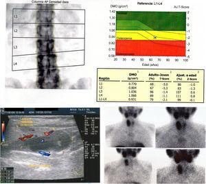 Radiological findings: densitometry with the presence of osteopenia in the spine. Neck ultrasound with suggested data of cystic lesion of the parathyroid glands. Parathyroid scintigraphy with hypercaptant nodular image in the upper pole of the right thyroid lobe and of less intensity in the lower pole of the same side.