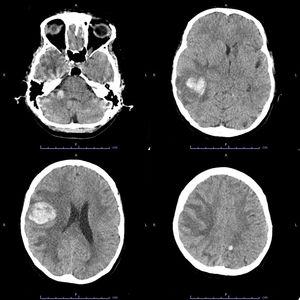 Hemorragia por metástasis cerebrales por carcinoma infiltrante de mama: a propósito de un caso