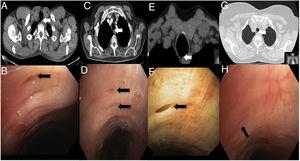 části A, B, C A D obsahují CT vyšetření hrudníku pro případy 1, 2, 3 a 4. Bílé šipky označují tracheální divertikulum. Části E, F, G A H ukazují fibrobronchoskopické skeny pro případy 1, 2, 3 a 4. Černé šipky označují spojení tracheálního divertikulu s tracheálním lumenem.