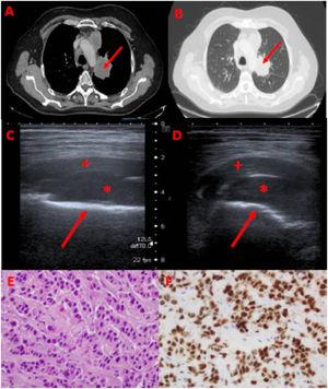 A y B) TC tórax: masa pulmonar central de 5,5 cm en lóbulo superior izquierdo (flecha). C y D) Ecografía musculoesquelética: masa de partes blandas de 10 x 3 cm (señalizada con asterisco), localizada entre la cortical anterior del fémur izquierdo (flecha) y el recto femoral izquierdo (cruz). E) Imagen de anatomía patológica (AP): tinción con hematoxilina-eosina. F) Imagen de AP: expresión positiva de TTF1 (origen pulmonar).