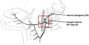 Esquema del trayecto del nervio hipogloso y zona de mayor posibilidad de lesión.