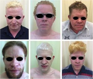 Fenótipo no albinismo. Ampla variabilidade fenotípica entre homens portadores de albinismo.