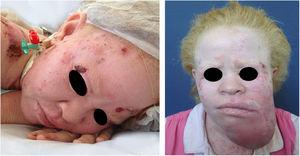 Morbimortalidade associada ao câncer da pele. Paciente albina jovem, apresentando múltiplos tumores ulcerados. Foi a óbito aos 27 anos devido a carcinoma espinocelular metastático.