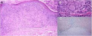 A, Adelgaçamento da epiderme, infiltrado liquenoide com linfócitos e histiócitos que forma granulomas não necrotizantes na derme e extravasamento de eritrócitos (hematoxilina & eosina, 100×). B, Pequenos granulomas não necrotizantes na derme, formados por acúmulos de células epitelioides e células gigantes multinucleadas (hematoxilina & eosina,400×). C, Extravasamento de eritrócitos e depósitos de hemossiderina na derme, especialmente abaixo do infiltrado inflamatório com granulomas (azul da Prússia,100×).