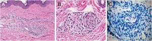 Anatomopatológico da dog‐ear:A, Infiltrado inflamatório superficial e profundo, perianexial; linfócitos e macrófagos com citoplasma vacuolizado (Hematoxilina & eosina, 400×); B, Delaminação do perineuro com infiltrado de linfócitos e macrófagos (Hematoxilina & eosina, 400×); C, Pesquisa de BAAR positiva, com bacilos íntegros e formação de globias (Fite‐Faraco, 1000×).