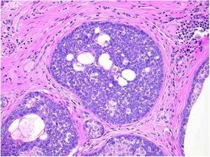 Sebaceoma. Detalhe de massas epiteliais dispostas em meio à derme. Nota‐se predomínio de células de núcleos redondos vesiculosos e de citoplasma escasso (sebócitos imaturos), permeadas, em menor número, por células de citoplasma pálido que contêm múltiplos vacúolos lipídicos, algumas com núcleos chanfrados (sebócitos maduros), dispostas aleatoriamente e associadas a esboço de ductos. Ausência de paliçada na periferia das massas (hematoxilina & eosina, 200×).