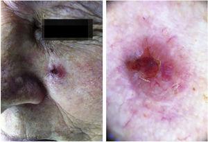 Aspecto clínico e dermatoscópico (aumento de 20×) de carcinoma basocelular localizado na região malar esquerda.