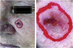 Delimitação do tumor com dermatoscópio.