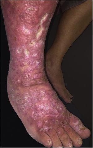 Placas eritematosas, infiltradas, de aspecto anular, com ulcerações, na perna e pé direitos.