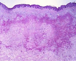 Ao exame histopatológico nota‐se granuloma em paliçada, constituído por histiócitos epitelioides e células gigantes multinucleadas, centrados por necrose fibrinoide com alguns neutrófilos e sinais de dano vascular na derme (Hematoxilina & eosina, 40×).