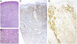 A, Cortes histológicos corados com Hematoxilina & eosina (20×) evidenciaram neoplasia na derme, composta de melanócitos atípicos sem conexão com a epiderme; B, Melanócitos atípicos (Hematoxilina & eosina, 40×); C, Imunomarcação com Melan‐A; D, Imunomarcação com HMB‐45.