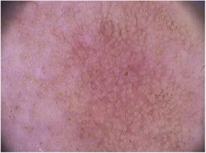 Imagem dermatoscópica (Fotofinder®, 20×) do padrão em “morango”, observado em ceratose actínica facial.