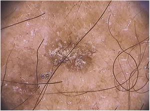 Dermatoscopia de ceratose actínica pigmentada extrafacial localizada no antebraço: observa‐se pigmento acastanhado homogêneo com escamas esbranquiçadas na superfície da lesão (Fotofinder®, 20×).