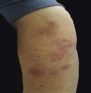 Múltiplas placas cutâneas arroxeadas, dolorosas, sem prurido e localizadas no braço esquerdo.