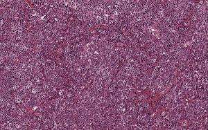 O tumor era composto de aglomerados de células ovais com citoplasma abundante, núcleos excêntricos e cromatina com aspecto de “mostrador de relógio” (Hematoxilina & eosina; 200×).