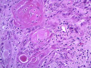 Blocos de células epiteliais atípicas com formação de pérolas córneas (Hematoxilina & eosina, 200×).