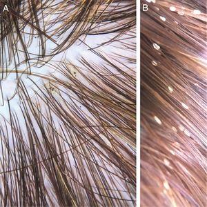 A, Pediculus capitis, no couro cabeludo (Foto cedida por Dr. Daniel França). B, Lêndeas, aderidas aos cabelos.