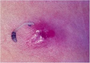 Miíase furunculoide. Lesão ulcero‐nodular e agente etiológico (Dermatobia hominis).