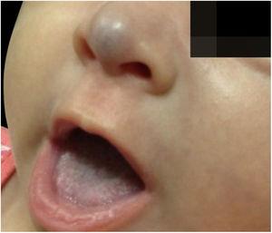 Antes do tratamento com propranolol oral, paciente com 2 meses.