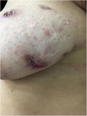 Lesões sugestivas de pioderma gangrenoso na mama esquerda: úlceras de bordas violáceas e subminadas.