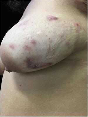 Lesões na mama esquerda apresentam melhora do quadro após dois meses de uso de adalimumabe SC.