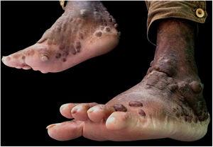 Face medial de pé direito e face lateral de pé esquerdo apresentam placas eritêmato‐acastanhadas.