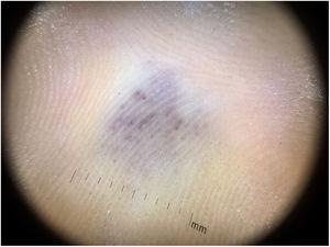 A dermatoscopia evidenciou padrão global homogêneo, de coloração violácea, com pontos vermelhos enegrecidos, distribuídos no interior da lesão.