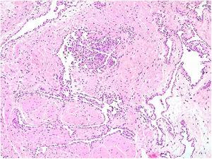 Histopatologia. Projeções papilares com eixos vasculares revestidas por células arredondadas e hipercromáticas – “células em tachão” (Hematoxilina & eosina, 100×).