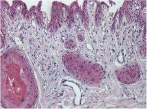 Histopatologia (Caso 1). Ilhotas epiteliais com ceratinização de sua porção central em grau variável, localizadas no tecido conjuntivo do leito ungueal (Hematoxilina & eosina, 400×).