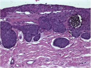 Histopatologia (Caso 2). Ninho juncional de células melanocíticas pigmentadas em relação com ilhotas epiteliais localizadas no tecido conjuntivo superficial do leito ungueal (Hematoxilina & eosina, 400×).