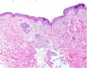 Esclerose leve da derme papilar, neovascularização e infiltrado inflamatório leve (Hematoxilina & eosina, 100×).