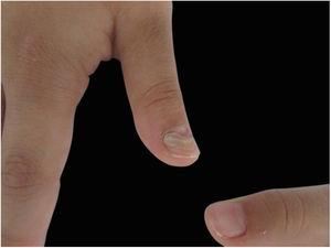 Detalhe do primeiro quirodáctilo da mão direita da paciente de 7 anos, mostrando o descolamento da unha antiga em relação à nova.