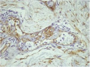 Imuno‐histoquímica para CD 34 (400×): positiva nas células endoteliais dos vasos e negativa nas células intraluminais.