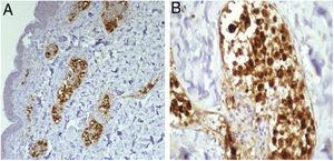 A, Imuno‐histoquímica para CD68, 200×: positiva nas células intravasculares. B, Detalhe da Figura A, 400×.