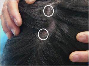 Manifestação clínica de tinha do couro cabeludo. Pequena perda de cabelo do tamanho de um feijão e “pontos pretos” espalhados na parte superior da cabeça (círculos brancos).