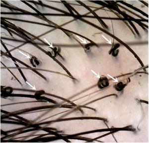 Dermatoscopia evidencia cabelos em saca‐rolhas (setas brancas, 40×).