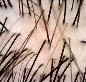 Dermatoscopia dos achados pós‐tratamento evidencia o desaparecimento dos cabelos em saca‐rolhas, 40×.