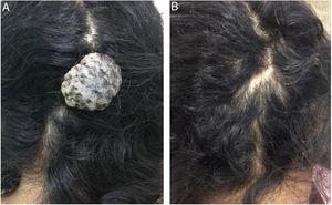 (A) Tumoração exofítica, pedunculada, de consistência fibroelástica, mede 3,0×2,0cm na região occipital do couro cabeludo; (B) Aspecto após exérese cirúrgica.