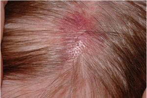 Placa eritematosa com início recente na cabeça de uma mulher de 60 anos.